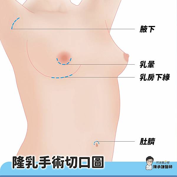 產後隆乳可選擇腋下切口或胸下切口比較適合