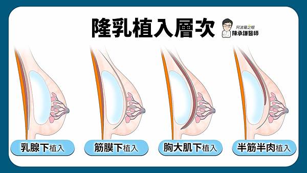 產後隆乳可考慮將假體放在胸大肌下或者半筋半肉的層次